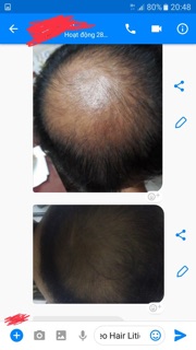 Thuốc xịt mọc tóc Neo Hair Lotion