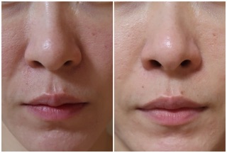 SERUM BORTOX MEDIPEEL HÀN QUỐC
