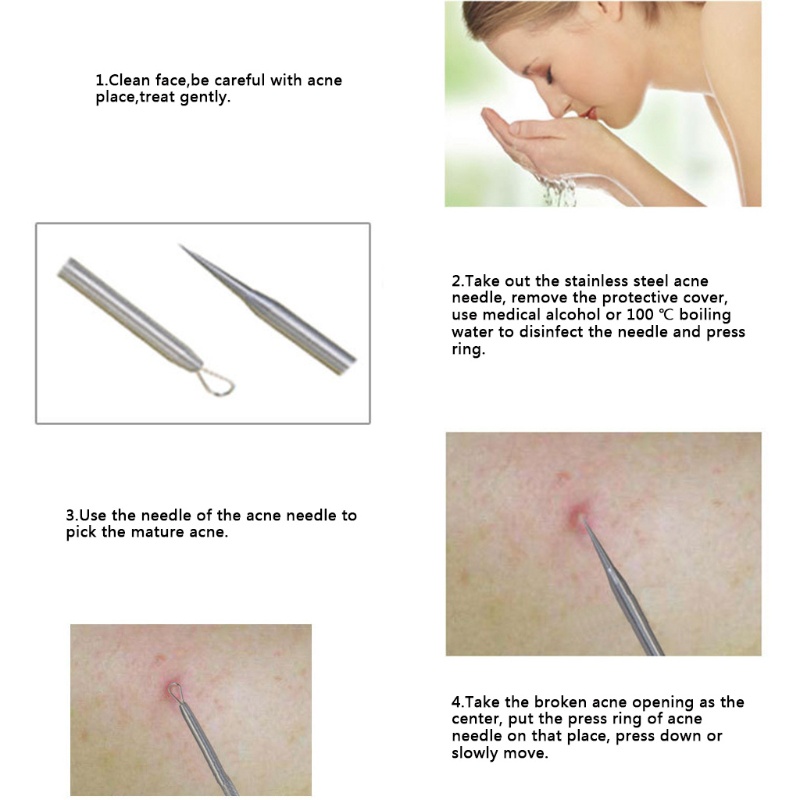 Dụng Cụ Nặn Mụn Hai Đầu Bằng Thép Không Gỉ YOUYO