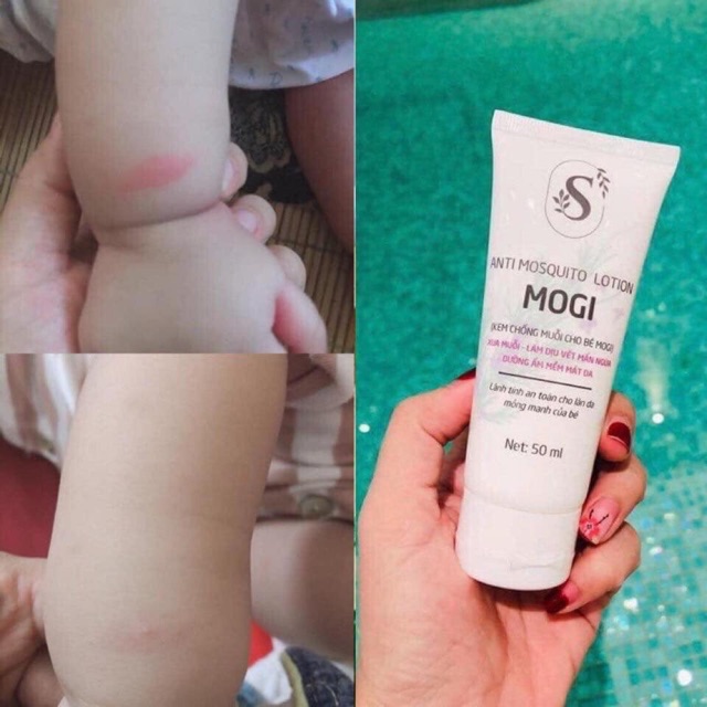 [SAM NATURAL] Kem Chống Và Trị Muỗi Đốt Mogi
