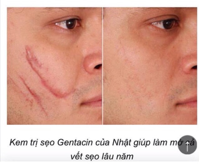 Kem Hỗ Trợ Cải Thiện Sẹo Gentacin Nhật Bản
