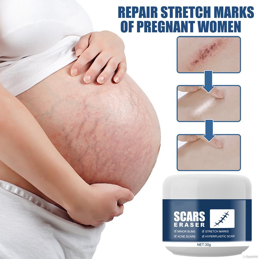 Multi-effect Scar Acne Cream Pimple Treatment Cream Scar Removal Cream- Stretch Marks Remover Cream For All Skin Types, New And