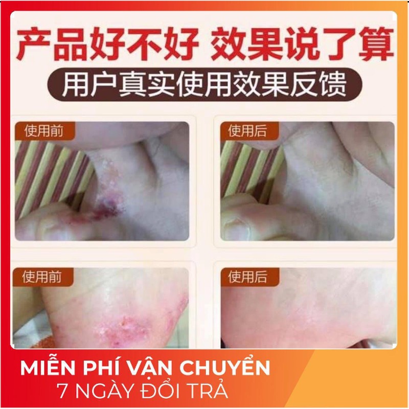 KEM DẦU NGỰA BÔI GIẢM NỨT, NẺ GÓT CHÂN, DA CHÂN TAY