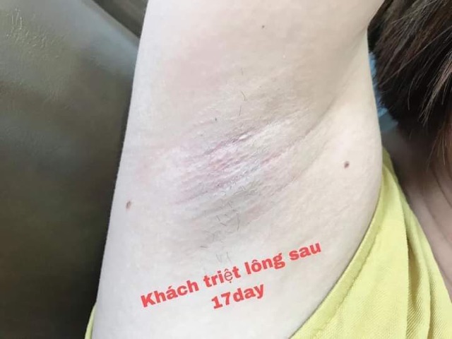 KEM TRIỆT LÔNG LORA CLEAN | BigBuy360 - bigbuy360.vn