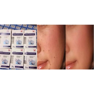 [ giá sỉ tại kho] Gel tẩy nốt ruồi lồi, mụn thịt, mụn cơm và sẹo lồi, thịt thừa Cynep hàng Nga chính hãng