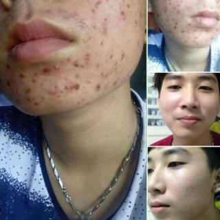 Thảo dược tái tạo da