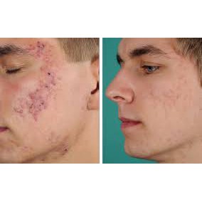 Kem mụn kracie | BigBuy360 - bigbuy360.vn