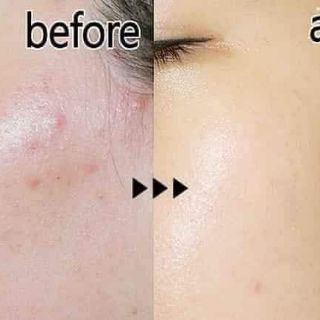 GEL CHẤM MỤN TRÀM TRÀ TBS