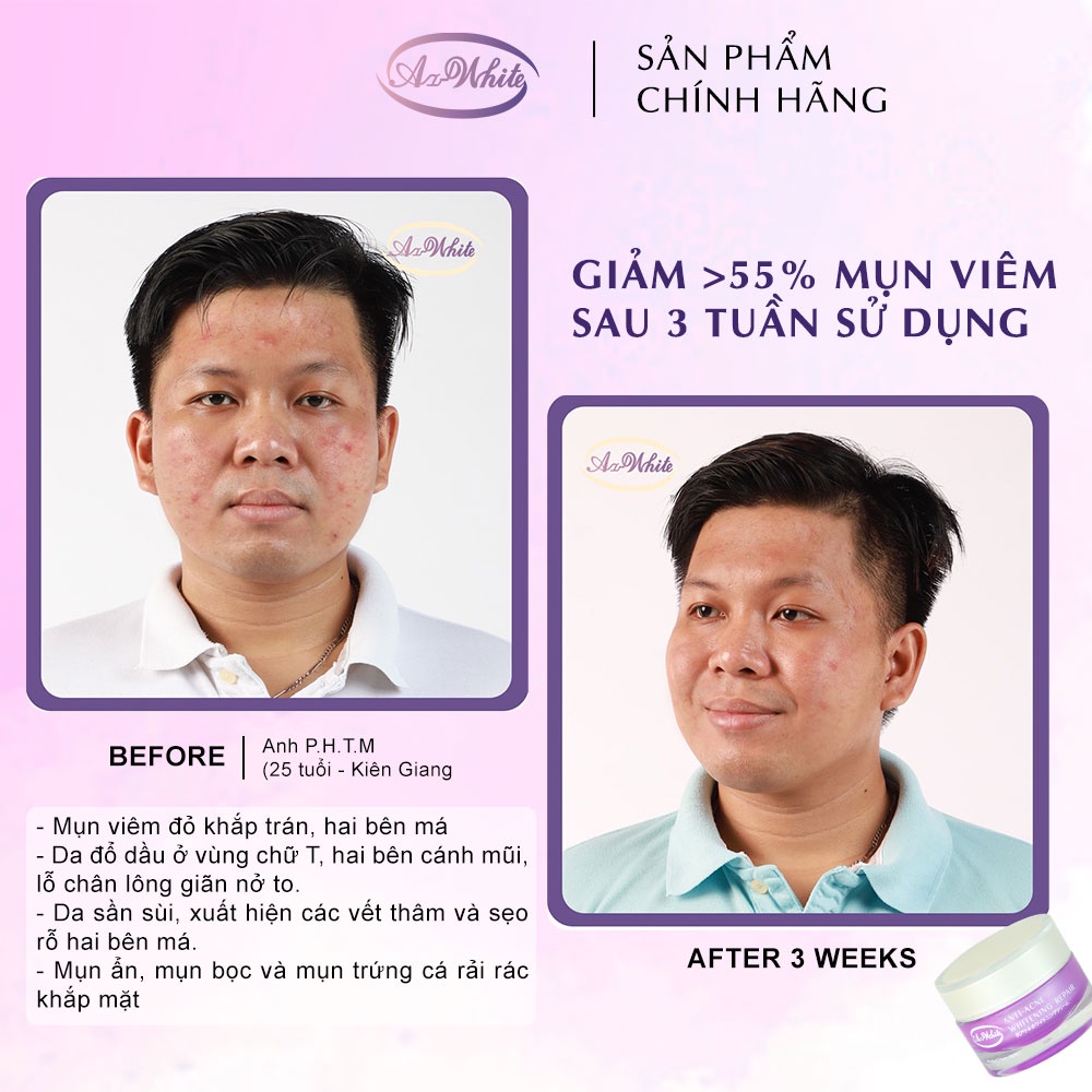 [COMBO TIẾT KIỆM] - 2 KEM GIẢM MỤN &amp; DƯỠNG TRẮNG DA A-WHITE 25G