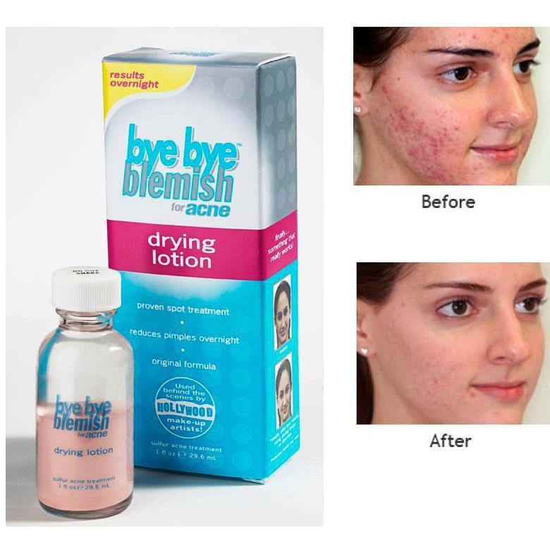 Lotion Làm sạch mụn Bye Bye Blemish Drying