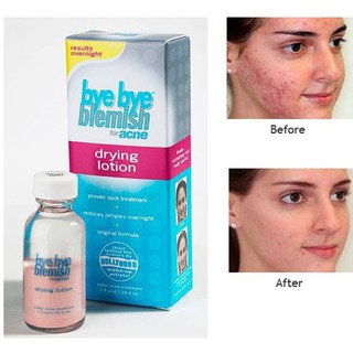 Lotion Chấm Mụn Bye-Bye Blemish For Acne