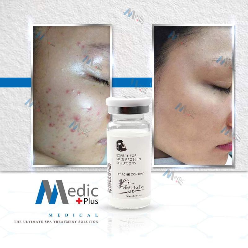 Serum mụn Medic Roller_ Tế bào gốc mụn Medic Roller | BigBuy360 - bigbuy360.vn