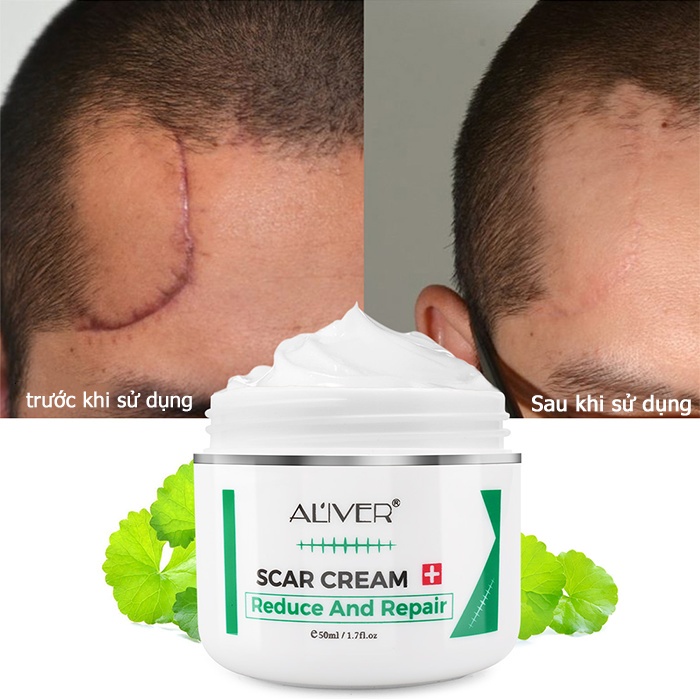EELHOE kem xóa sẹo, xoá sẹo bỏng,sẹo mụn,sẹo trầy xước.khổi phục da nhanh chóng,xóa rạn da,kem xóa sẹo