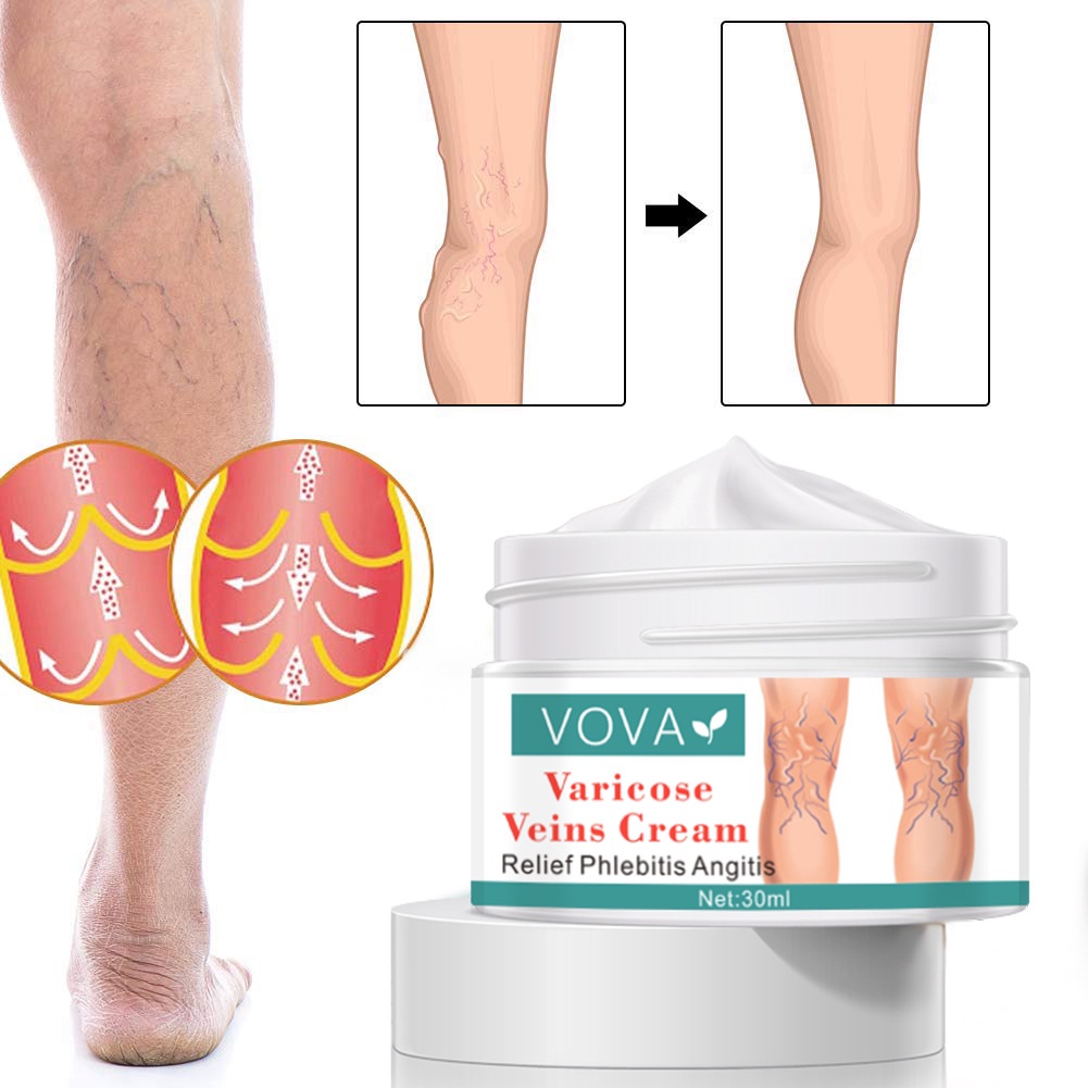 Kem giãn tĩnh mạch VOVA , sửa chữa các mao mạch, VOVA varicose veins cream 30ml