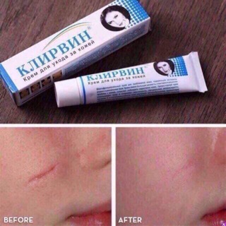Kem sẹo Klirvin Nga