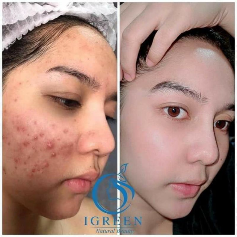 Serum SẠCH MỤN DIẾP CÁ IRGEEN_ GIẢM MỤN, GIẢM THÂM , SE KHÍT LỖ CHÂN LÔNG, SÁNG DA | BigBuy360 - bigbuy360.vn