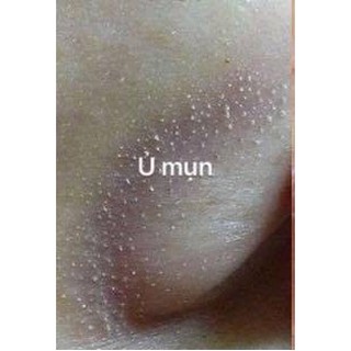 Ủ Mụn Đầu Đen , Mụn Cám Youngerc [ 30ml ]