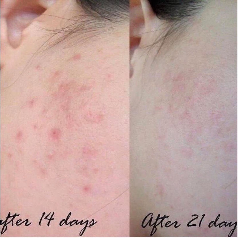 Serum Vitamin C, Serum Trắng Da Balance Active Formula Brightening 30ml Ngừa Thâm Cấp Ẩm Chống Lão Hóa