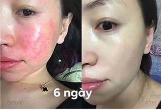 PHỤC HỒI BEEN CHO DA HƯ TỔN