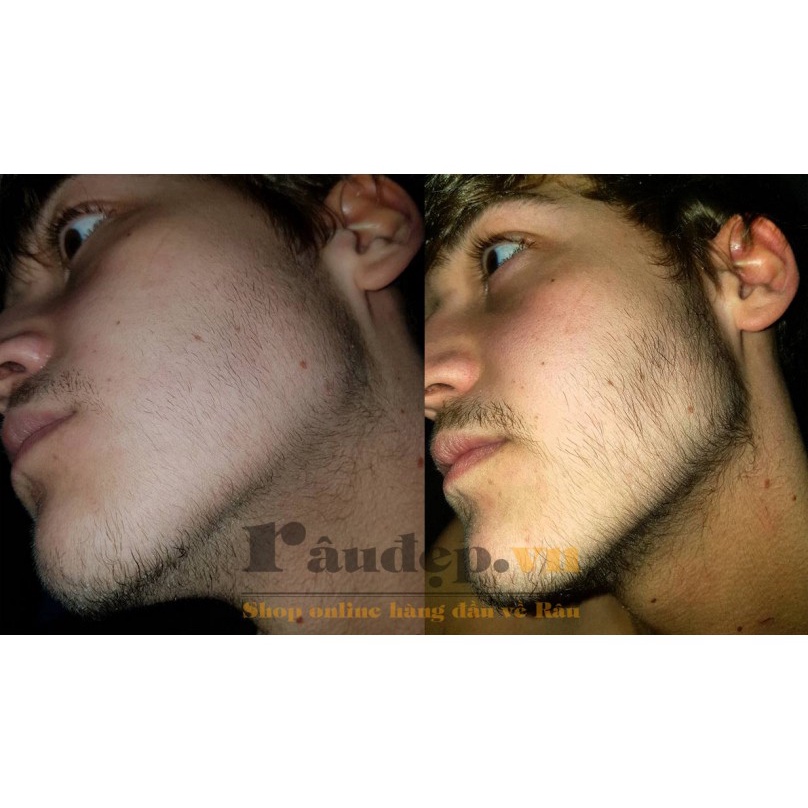 Minoxidil 5% Hỗ Trợ  Mọc Râu Tóc Kirkland