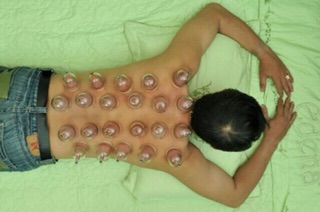 Giác hơi không dùng lửa Duy Thành