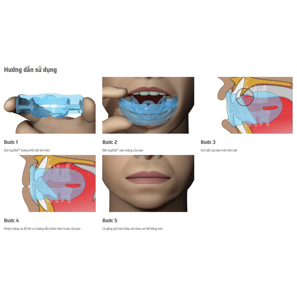 Chống Ngáy Cho Trẻ Em (6-12T) - MYOSA® FOR KIDS + Tặng Nước Súc Miệng Therabreath