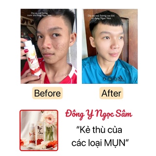 TINH CHẤT NGỌC SÂM NGỪA MỤN TRẮNG DA - 150ML