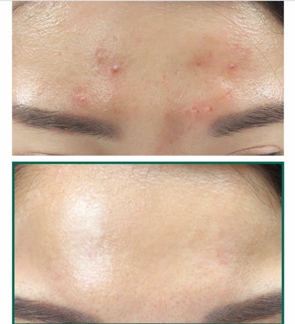 Nước hoa hồng da mụn AHA-BHA-PHA 30 Days Miracle Toner Some By Mi | BigBuy360 - bigbuy360.vn