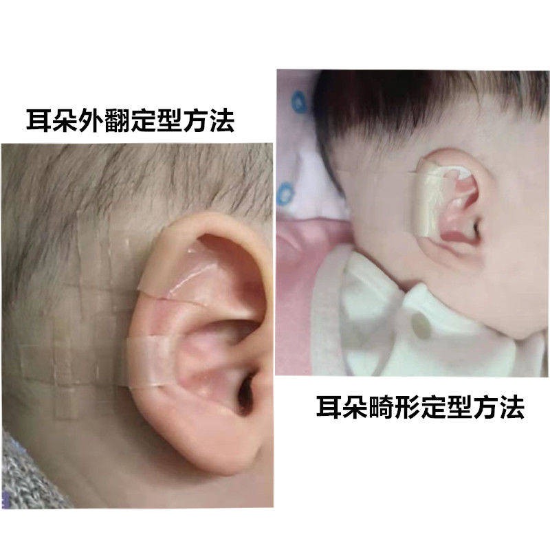 Infant silicone hồ sơ sửa chữa bé chống lừa đảo chính xác tai mới cố định biến dạng thể hiệnnội  địa