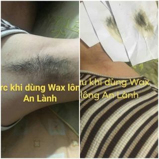 TRIỆT LÔNG NÁCH AN LÀNH