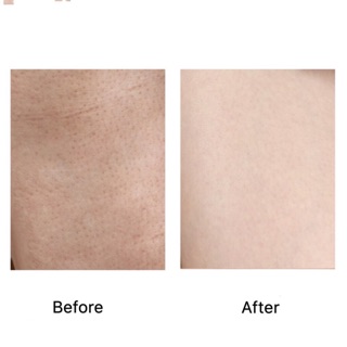 MUỐI TẨY TẾ BÀO VERBENA LINN