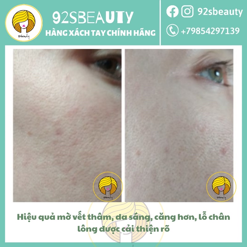 Tẩy da chết hoá học Teana Blue Retinol Rejuvenating Peel cho da căng bóng, láng mướt, giảm mụn