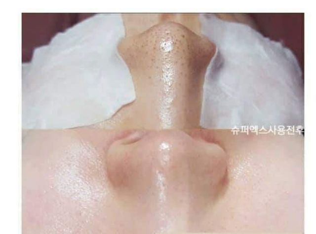 SIÊU Ủ MỤN CỦA MĨ SUPER X LOTION 1LÍT