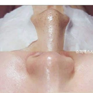 SIÊU Ủ MỤN CỦA MĨ SUPER X LOTION 1LÍT