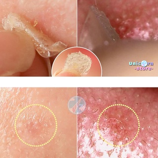Miếng Dán Hỗ Trợ Giảm Mụn Clear Spot Patch 36 Miếng