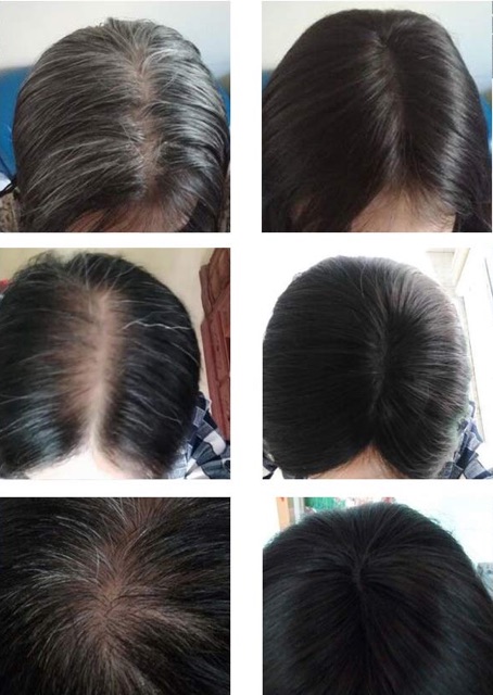 Tóc Thật Đỉnh Đầu Che Hói