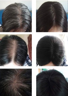 Tóc Thật Đỉnh Đầu Che Hói