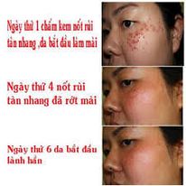 Kem Chấm Xóa Nốt Ruồi, Tàn Nhang, Thịt Dư, Mụn Cóc