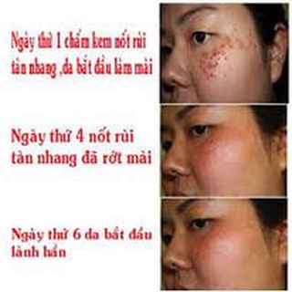Kem xóa ruồi ,  mụn thịt , tàn nhang