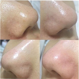 Ủ MỤN ĐẦU ĐEN MEDIPEEL