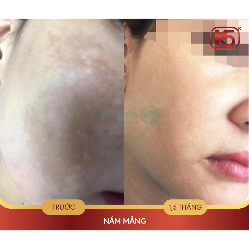 Kem xóa nám mảng, nám chân sâu và nám sau sinh K5 Lipogel 40ml - hiệu quả đã được khẳng định