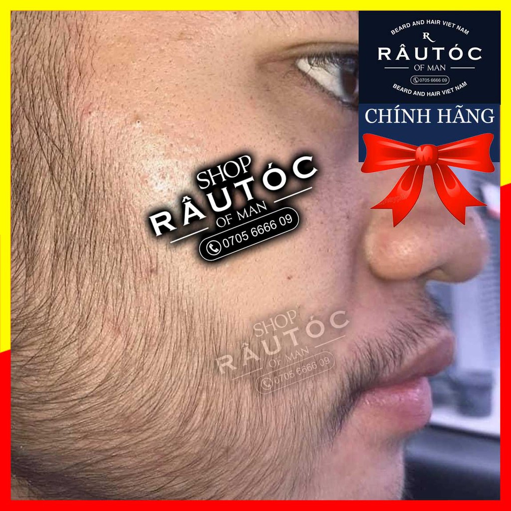 Thuốc mọc râu Minoxidil 5% hộp 6 lọ dạng lỏng