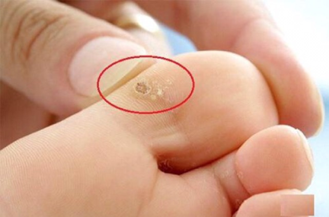 Gel Tẩy mụn thịt, mụn cóc , mục ruồi | BigBuy360 - bigbuy360.vn