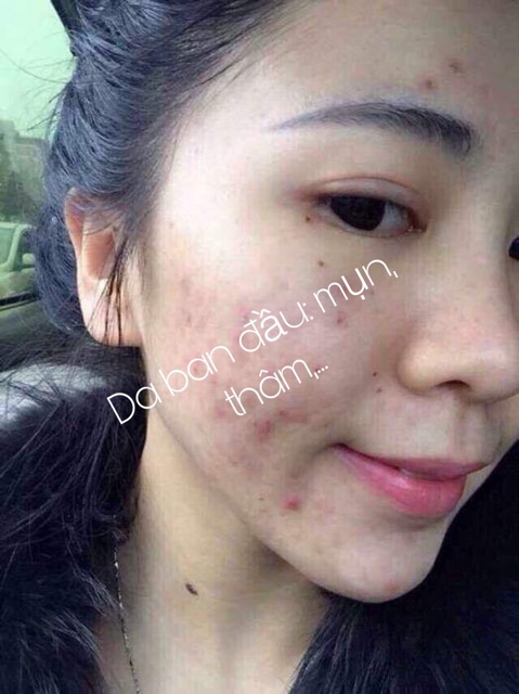 Peel TCA Zenus 50% | BigBuy360 - bigbuy360.vn