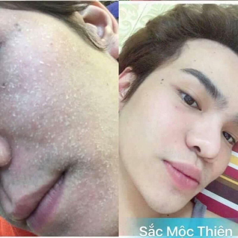 Tái Tạo Da Sắc Mộc Thiên