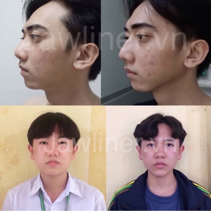 [CHÍNH HÃNG JAWLINER ĐỨC] Bộ gồm 2 viên Jawliner tập cơ hàm giảm mỡ nọng phát triển cơ, mũi và jawline - Jawliner.vn