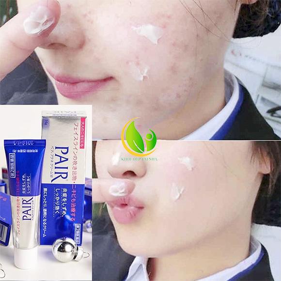 [NỘI ĐỊA NHẬT] Kem ngừa mụn Pair Acne W Cream Nhật Bản 24g