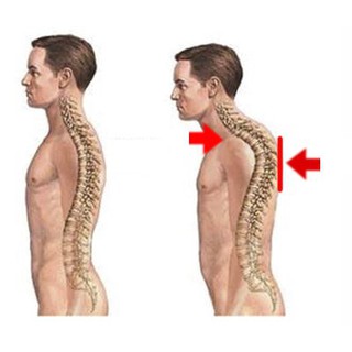 Nẹp Lưng - Đai Lưng Chống Gù Nhật Bản