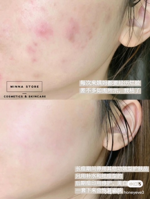 KEM DƯỠNG DA MỤN KRACIE HADABISEI FACIAL CREAM ACNE CARE