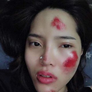 Kem hỗ trợ trị sẹo Hiruscar